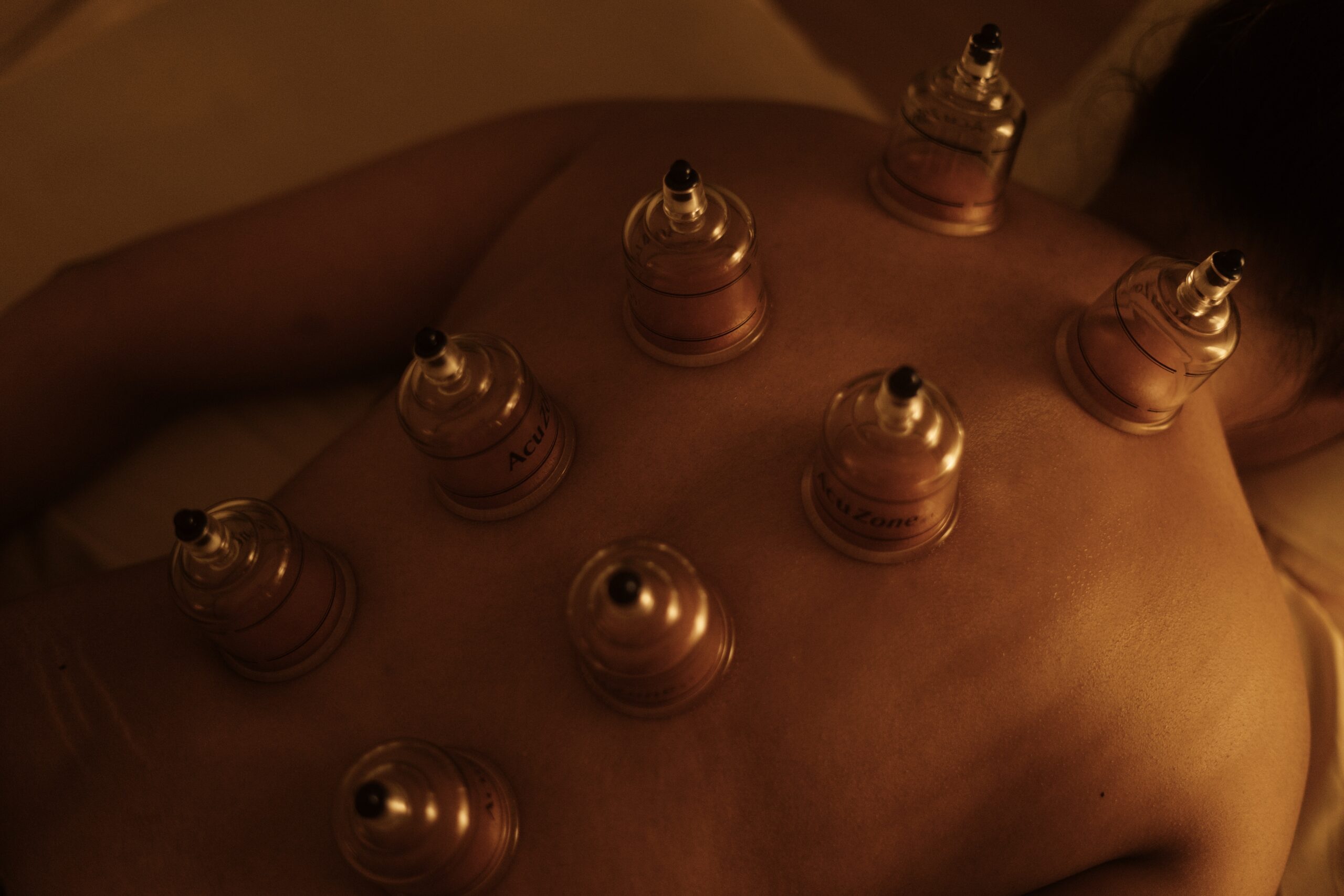 Relieve Pain with Cupping Therapy at NYPPT